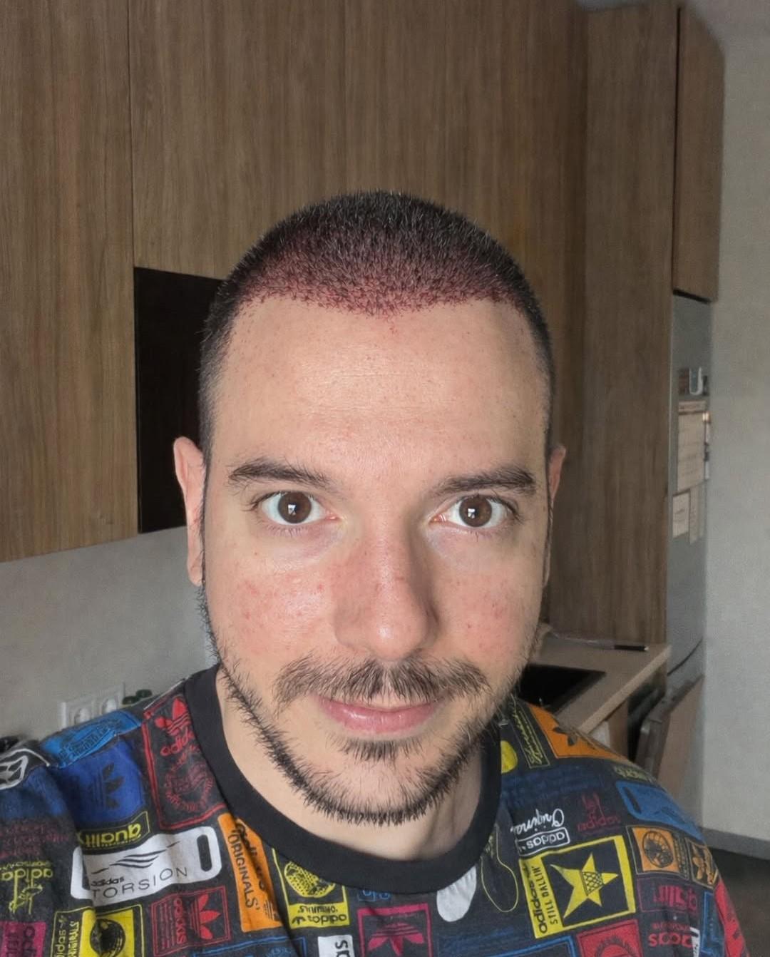 Цитиридис си присади коса